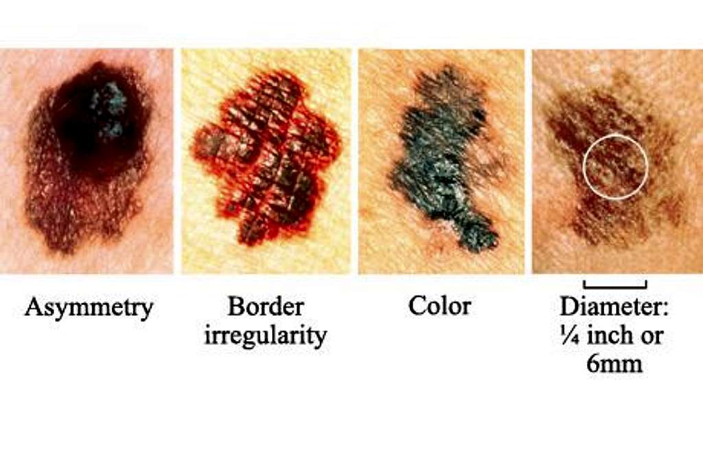 ABCD Skin Cancer