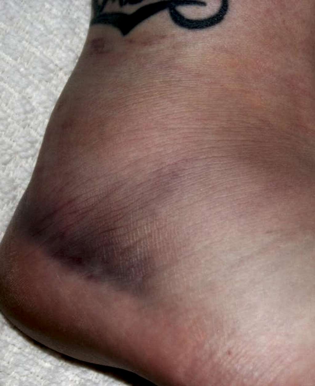 My Ankle Now (3 days later 2)
