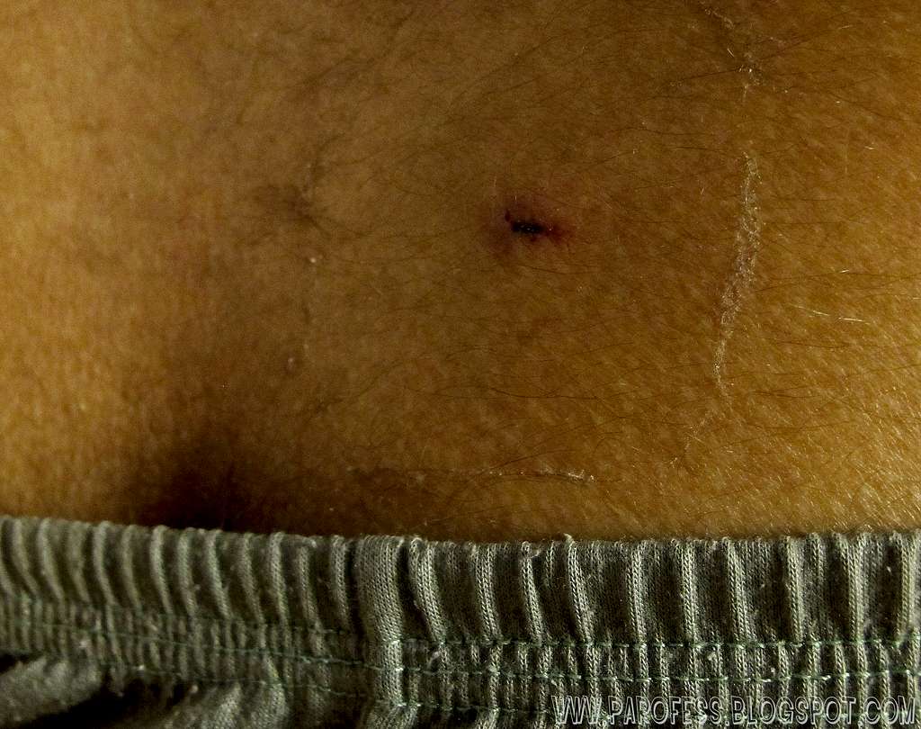 The little hole on my back
