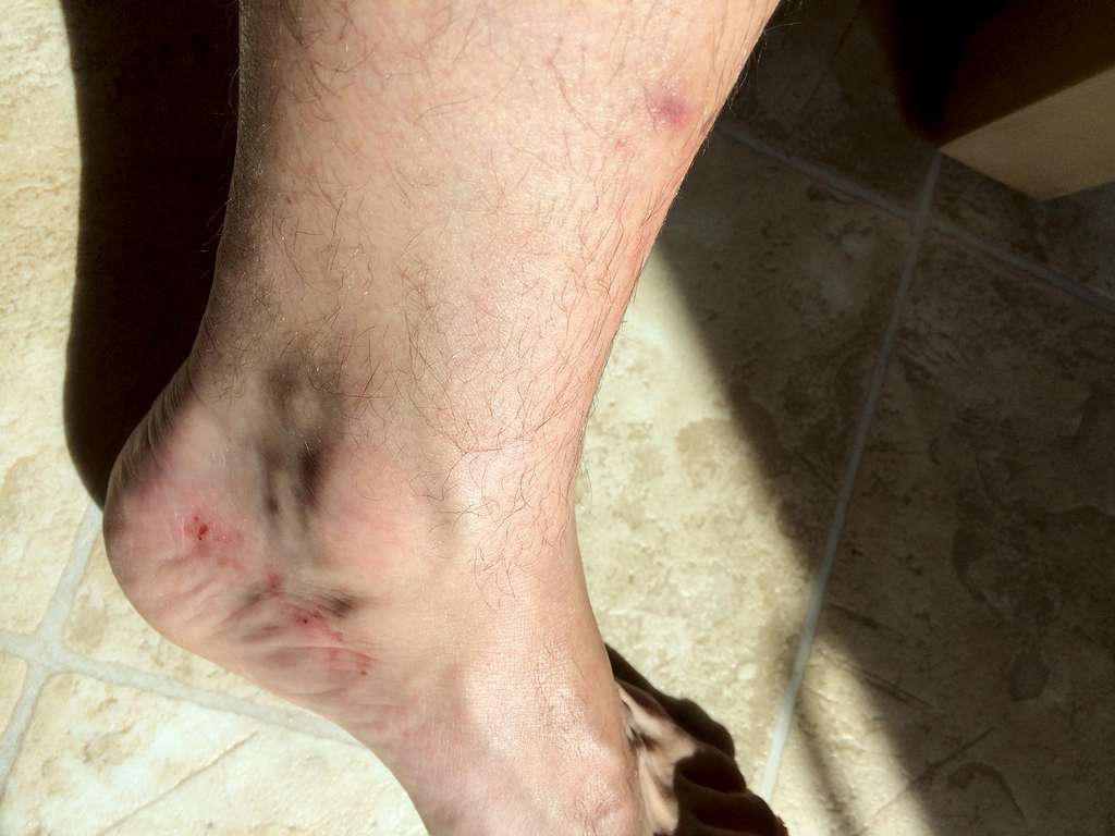 foot damage 3