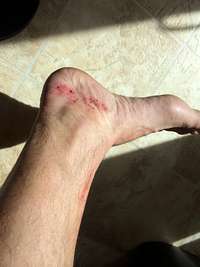foot damage 1