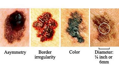 ABCD Skin Cancer