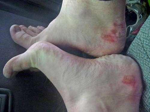 Blistered Feet