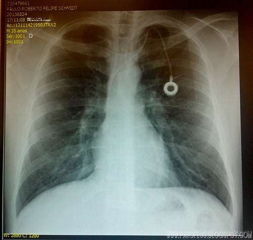 Super cool X ray view of Parofes' Port a Cath!